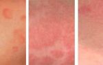 Лечение контактного дерматита: признаки и виды высыпаний на разных стадиях болезни, причины возникновения и особенности течения заболевания у взрослых и детей