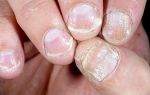 Лечение псориаза ногтей медикаментозными и народными средствами