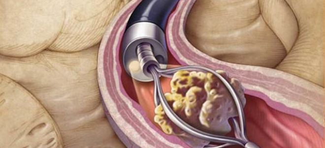 Как вывести камень из мочеточнике в домашних условиях: консервативная терапия, инструментальные и народные способы лечения