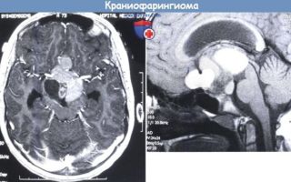 Краниофарингиома головного мозга: удаление, последствия и выживаемость
