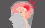 Сотрясение мозга: симптомы и признаки, степени тяжести, лечение и последствия