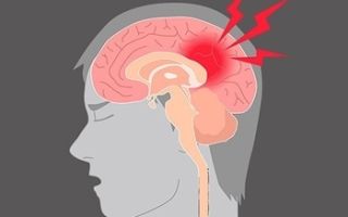 Сотрясение мозга: симптомы и признаки, степени тяжести, лечение и последствия