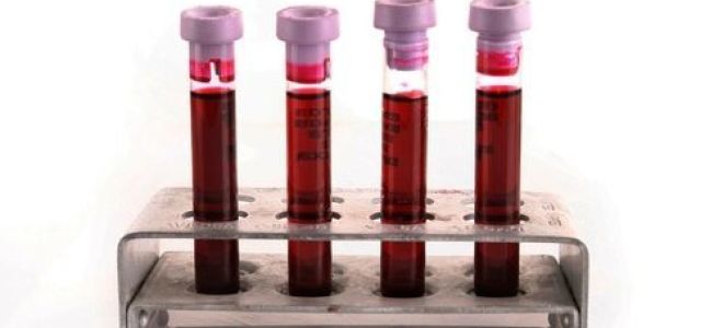 Анализ крови на ПСА у мужчин: что это такое, нормы по возрасту (общий и свободный), причины повышения, диагностика и лечение