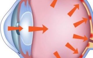 Симптомы глаукомы: факторы риска развития заболевания, лечение и профилактика болезни зрения, показания к проведению операции