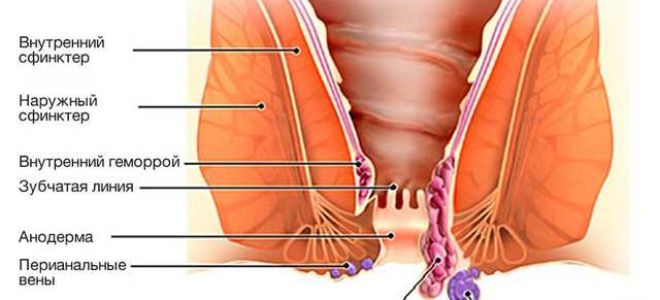 Внутренний геморрой: 5 первых признаков, симптомы, 4 метода лечения