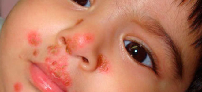 Что такое импетиго и как его лечить: разновидности заболевания и их особенности, факторы риска, обследование и методы терапии