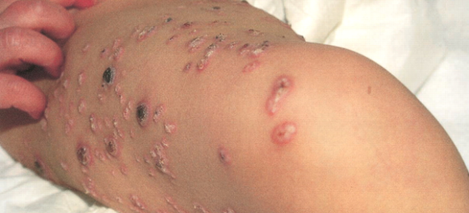 Опоясывающий лишай: причины, симптомы и лечение