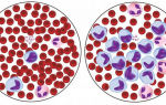 Норма лимфоцитов у детей в анализе крови: таблица, расшифровка lym