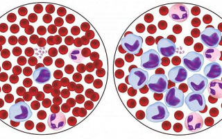 Норма лимфоцитов у детей в анализе крови: таблица, расшифровка lym