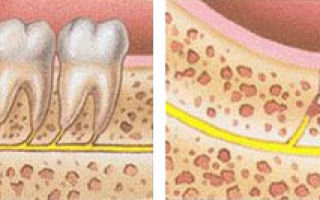 Отек щеки после удаления зуба: почему появляется, сколько держится, как снять в домашних условиях