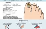 Чем лечить грибок ногтей на ногах в домашних условиях: действенные лекарственные препараты и народные средства, советы врачей