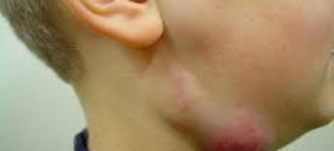 Почему воспаляются лимфоузлы на шее у ребенка с одной или с обеих сторон, слева или справа, как и чем их лечить