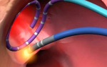 Радиочастотная абляция сердца (РЧА): показания к операции, осложнения, реабилитация