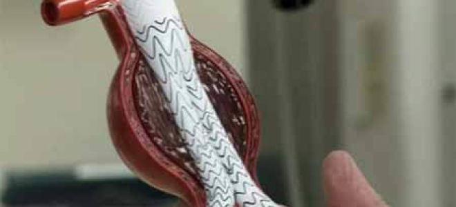 Лечение аневризмы аорты — действенные и распространенные методики