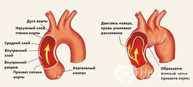 Аневризма аорты: симптомы, что это такое, расширение восходящего отдела, корня