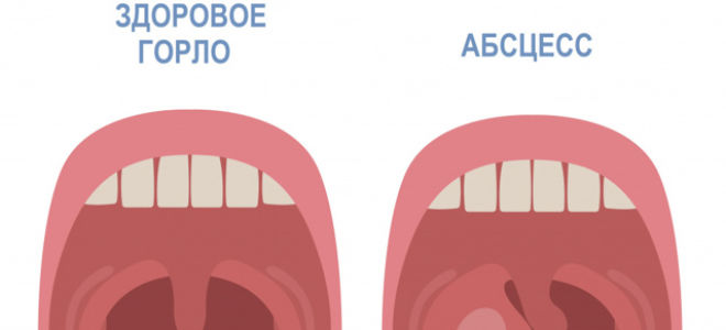 Воспаление миндалин: как выглядят воспалённые гланды, симптомы, без температуры, лечение, лекарства и препараты, чем полоскать горло, что делать, если болеет ребёнок