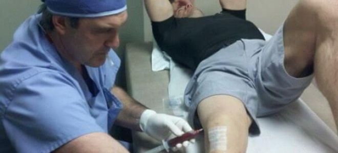 Синовит коленного сустава: классификация и формы заболевания, способы лечения, прогноз и профилактика