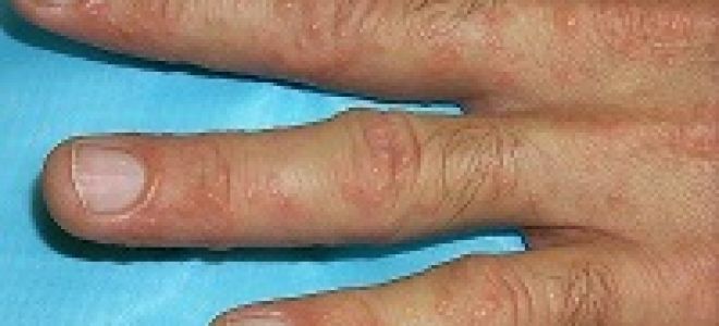 Как лечить онихолизис на ногах в домашних условиях: аптечные и народные средства, меры профилактики