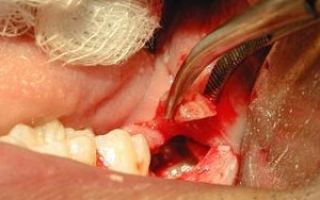 Альвеолит лунки после удаления зуба: причины и виды заболевания, характерные признаки, возможные осложнения и методы лечения