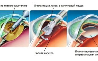 Замена хрусталика глаза: операция, цена, послеоперационный период