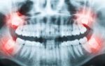 После удаления зуба болит десна: что делать с сильной болью после удаления зуба мудрости