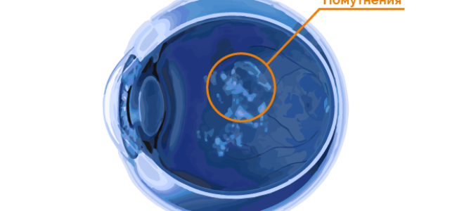 Мушки в глазах: причины, лечение, возможные последствия