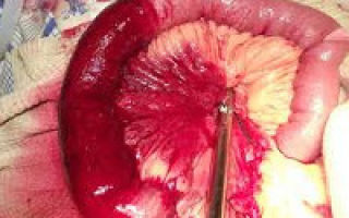 Тромбоз мезентериальных сосудов кишечника: симптомы и стадии, лечение и прогноз