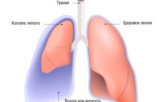 Диссеминированный туберкулёз лёгких заразен или нет