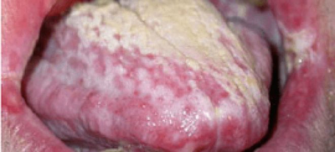 Кандидоз полости рта: причины заболевания, сопутствующие признаки и методы лечения