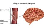 Инсульт мозжечка головного мозга (мозжечковый): лечение, последствия, прогноз продолжительности жизни