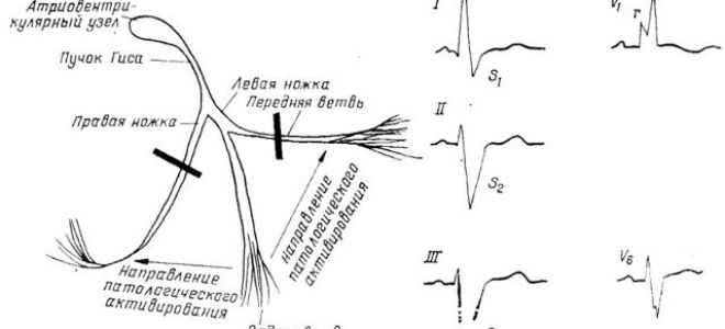 Нарушения внутрижелудочковой проводимости: понятие, о чем говорят, представление на ЭКГ, когда опасны