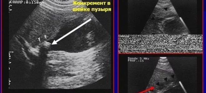 Калькулезный холецистит: причины заболевания, характерные симптомы и способы лечения