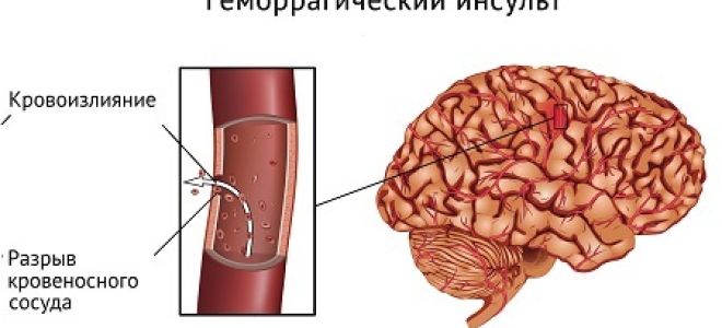 Субдуральная гематома (кровоизлияние) головного мозга: признаки, лечение, последствия