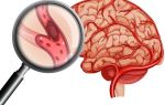 Ишемический инсульт: инфаркт головного мозга, что это такое, прогноз для жизни, лечение