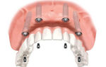 Сколько стоит поставить имплант одного зуба, где дешевле, как вставляют импланты