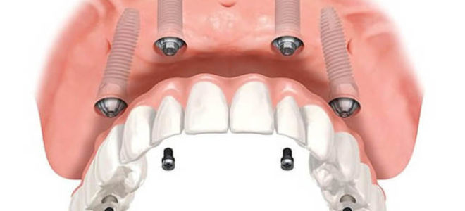 Сколько стоит поставить имплант одного зуба, где дешевле, как вставляют импланты