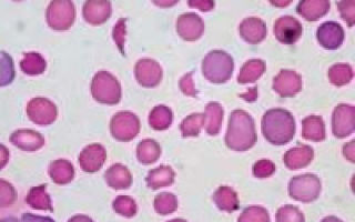 Гемолиз крови при сдаче анализов: что это такое, гемолизированная кровь