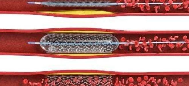 Лейкоэнцефалопатия головного мозга: симптомы, лечение и прогноз