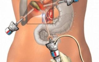 Операция лапароскопия желчного пузыря — подготовка, проведение, последствия