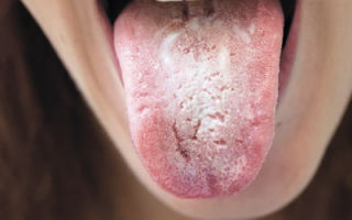 Болезни языка: симптомы и описания заболеваний языка, чем лечить, фото