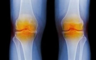 Причины синовиального хондроматоза коленного сустава, классификация, хирургическое лечение