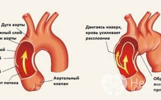 Аневризма грудного отдела аорты, восходящей дуги — как развивается, проявления и диагностика, лечение