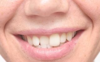 Скобы на зубы для детей и взрослых: фото «до и после», сколько стоят зубные скобы
