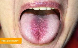 Белый налет на языке у взрослых: причины, симптомы, лечение заболеваний