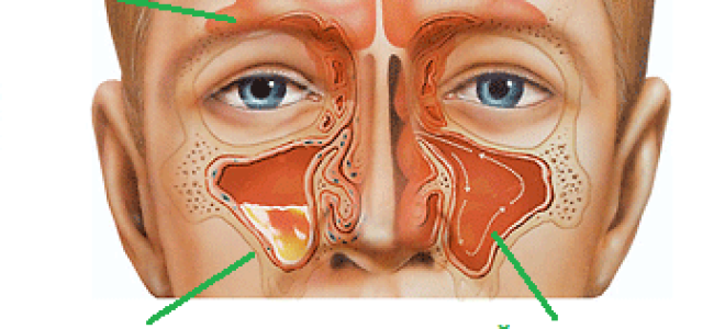Хронический гайморит: причины, симптомы и комплексное лечение