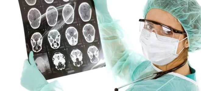 Желудочки головного мозга: строение, функции, особенности