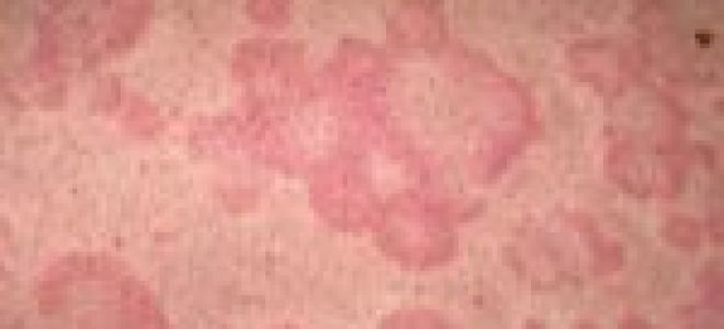 Как лечить крапивницу средствами народной медицины