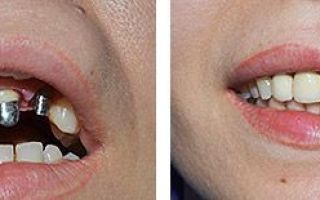 Какие коронки лучше ставить на передние зубы: виды, фото до и после, стоимость