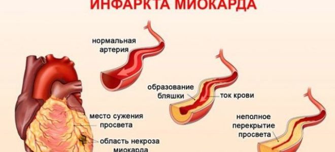 Микроинфаркт: как распознать, причины, помощь, как лечить