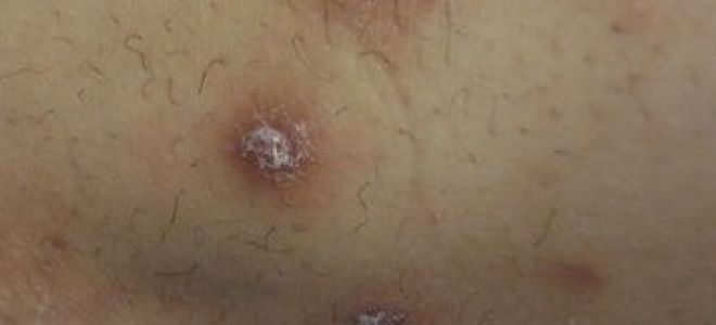 Чем лечить почесуху у взрослых в домашних условиях: разновидности и симптомы заболевания, лучшие народные рецепты и аптечные препараты для борьбы с пруриго